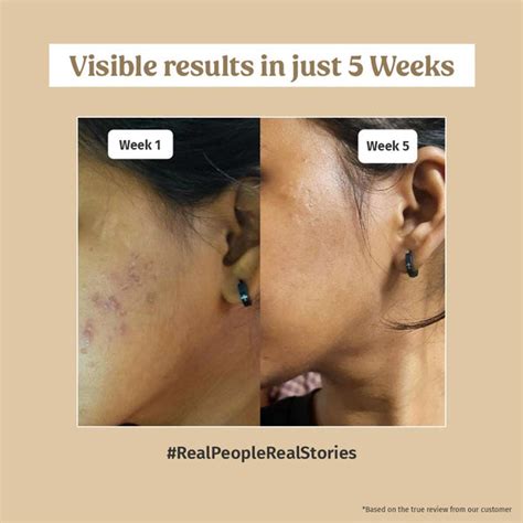 Skin Brightening Combo Products Online - Vilvah