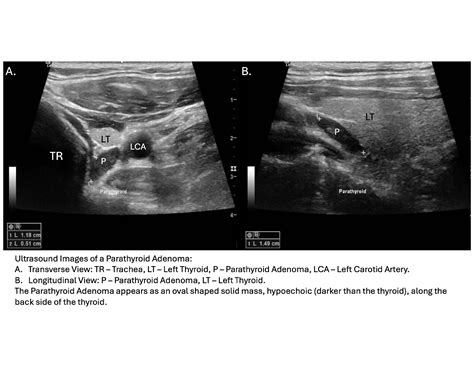 Parathyroid Ultrasound: Essential for Accurate Diagnosis
