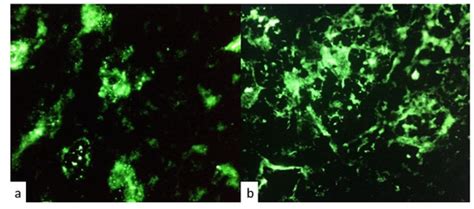 Pituitary Enlargement and Hypopituitarism in Patients Treated with ...