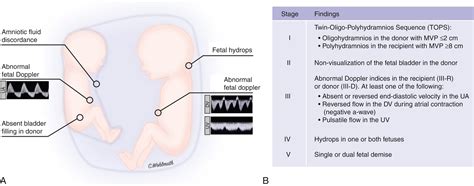 The Pathophysiology of Twin-Twin Transfusion Syndrome, Twin-Anemia ...