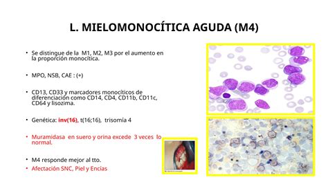 Leucemia Mieloide Aguda abordaje diagnostico | PPT