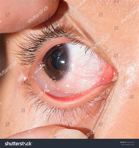 Close Up Of Chemosis Injected Allergic Eye During Eye Examination. Stock Photo 333322142 ...