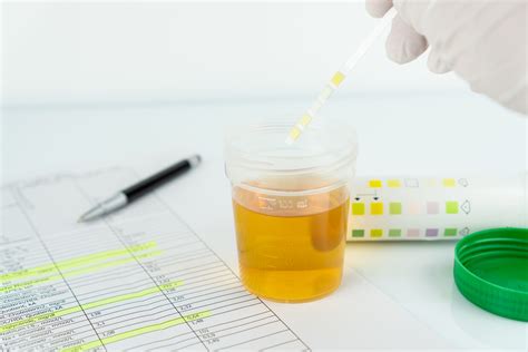 What a Urinalysis Tells Your Urologist - AARE UROCARE - Female Urology | Urinary Incontinence ...