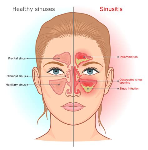 A Sinus Fungal Ball Causes Problems Galore - Suzy Cohen, RPh offers natural remedies to help you ...
