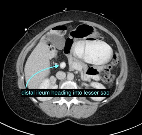 Foramen Of Winslow
