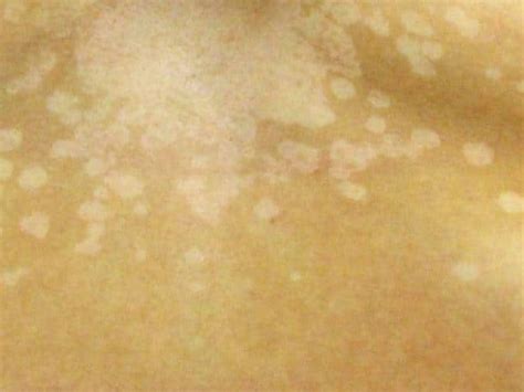 Vitiligo Leukoderma Symptoms : अंगावर पांढरे चट्टे दिसतात? या मुळे ...