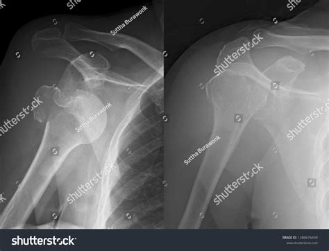 Humerus X Ray Anatomy
