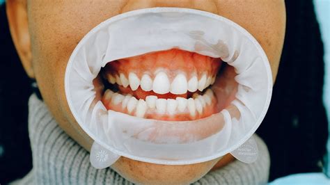 Normal SpO2 Range Adult 的图像结果