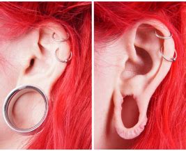 Ear Lobe Correction in Bangalore | Safe & Advanced Cosmetic Surgery