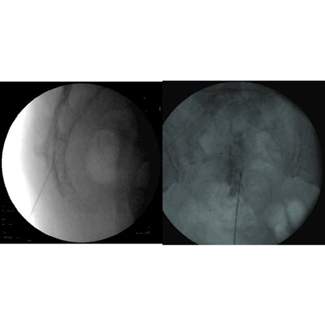 Effectiveness of Epidural Methylprednisolone Injection in Management of Lumbar Prolapsed ...