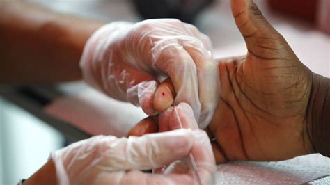 Scrub Typhus – a Re-Emerging Disease India Can No Longer Afford to Ignore