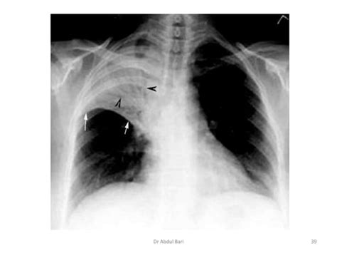 Image result for Chest X-Ray Tutorial