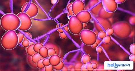 Candidiasis : कैंडीडायसिस के कारण, लक्षण, उपचार और घरेलू उपाय हैलो ...