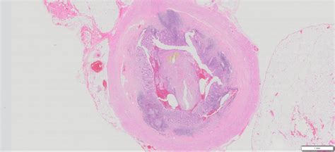 Image result for Normal Appendix Real