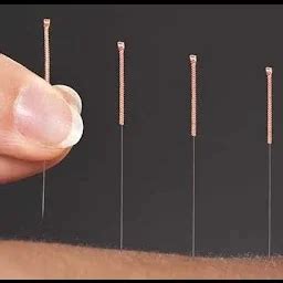 Best Top Rated Acupuncture clinic in Hyderabad, Telangana, India | Yappe.in