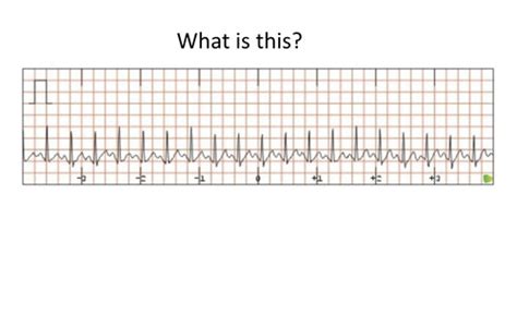 Abnormal ECG patterns Flashcards | Quizlet