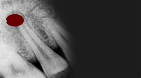 Painfree RCT Root Canal Treatment Ahmedabad Gujarat India,Dental Clinic ...