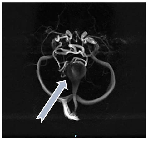 Vein of Galen Malformation—Experience of the Last 13 Years in a ...