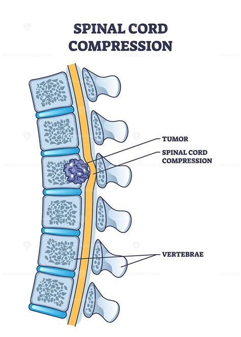 Spinal Cord Compression 的图像结果