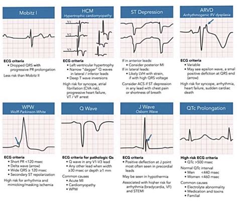 Ecg interpretation characteristics of the normal ecg p wave qrs complex ...