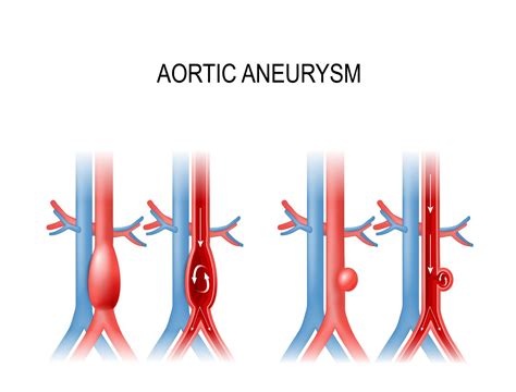 Recommendations for Abdominal Aortic Aneurysm Screening - AAPC Knowledge Center