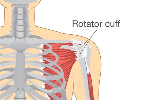 Rotator Cuff Surgery
