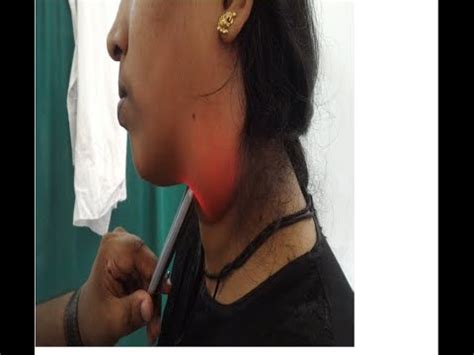 Image result for Transillumination