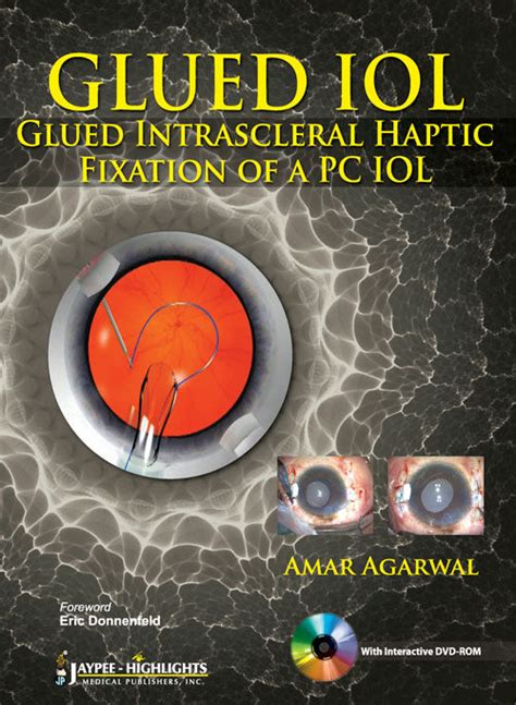 GLUED IOL GLUED INTRASCLERAL HAPTIC FIXATION OF A PC IOL WITH DVD-ROM ...