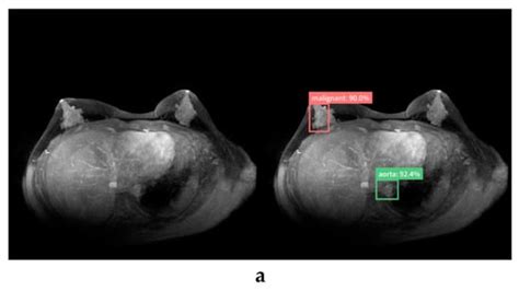 Detection and Diagnosis of Breast Cancer Using Artificial Intelligence ...