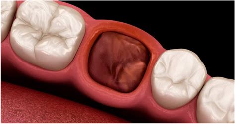 Image result for Healed Tooth Extraction