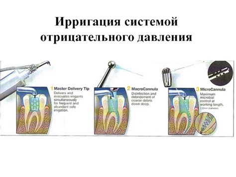 Ирригации корневых каналов презентация, доклад