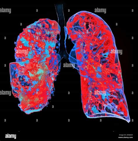 Pneumonia, 3D CT scan Stock Photo - Alamy