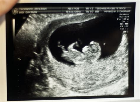 12 Weeks Pregnant Ultrasound Gender