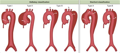 The Aorta - Clinical Tree