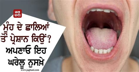 ਮੂੰਹ ਦੇ ਛਾਲਿਆਂ ਤੋਂ ਪ੍ਰੇਸ਼ਾਨ ਕਿਉਂ? ਅਪਣਾਓ ਇਹ ਘਰੇਲੂ ਨੁਸਖ਼ੇ