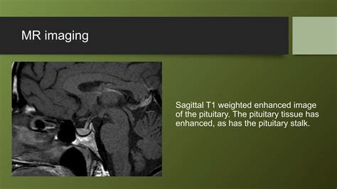 Pituitary gland MRI | PPTX