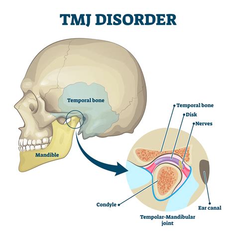 Tmj Nerve Damage Symptoms