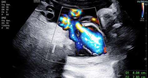 Intra‐amniotic umbilical vein varix: A case report and review of the literature - Nasser - 2023 ...