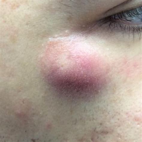 Pictures of Cysts Under the Skin | Common Types & Examples