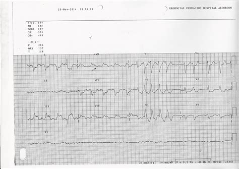 BLOQUEO DE RAMA IZQUIERDA | cardiomap