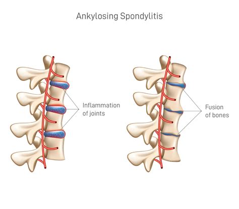 Ankylosing Spondylitis Treatment, Causes & Symptoms | QI Spine Clinic
