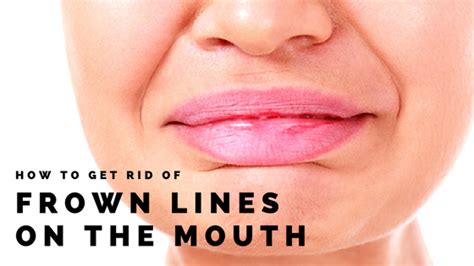 How To Get Rid Of Frown Lines On The Mouth - Erase Cosmetics