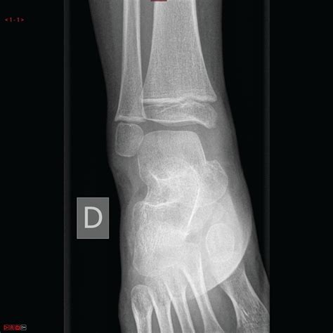 Talus fracture in a 4-year-old child | BMJ Case Reports