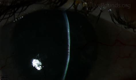 Atlas Entry - Riley-Day Syndrome (Familial Dysautonomia) with ...