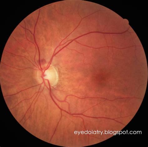 What's That In My Retinal Photo? Hemorrhage at the Nerve - Eyedolatry