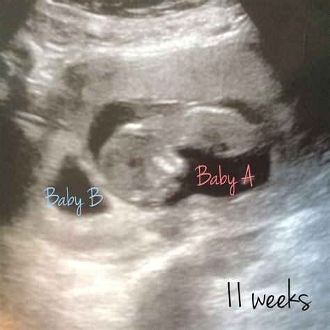 Albums 94+ Pictures Ultrasound Pictures Of Twins At 4 Weeks Updated