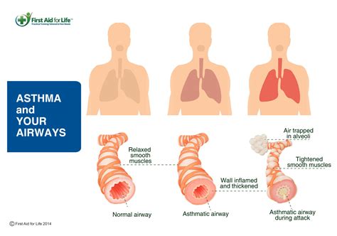 Asthma | Stay Safe for Older People