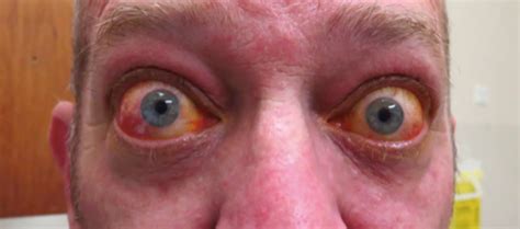 Graves Disease Eyes Bulging