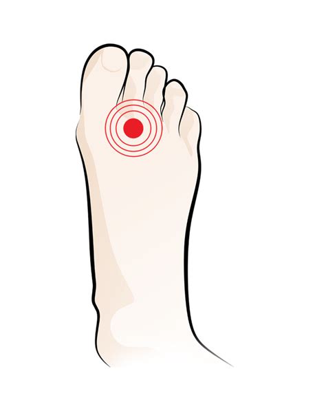 Buy Orthotics for Morton's Neuroma Online in India (Insoles)