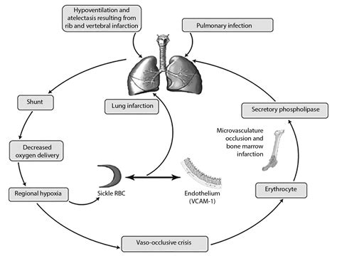 Sickle Cell Emergencies | 2018-05-07 | AHC Media -… | Clinician.com